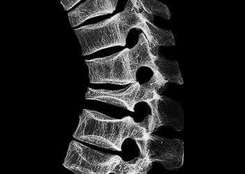Roentgenbild einer Lendenwirbelsäule mit Osteoporose Roentgenbild einer Lendenwirbelsäule mit Osteoporose